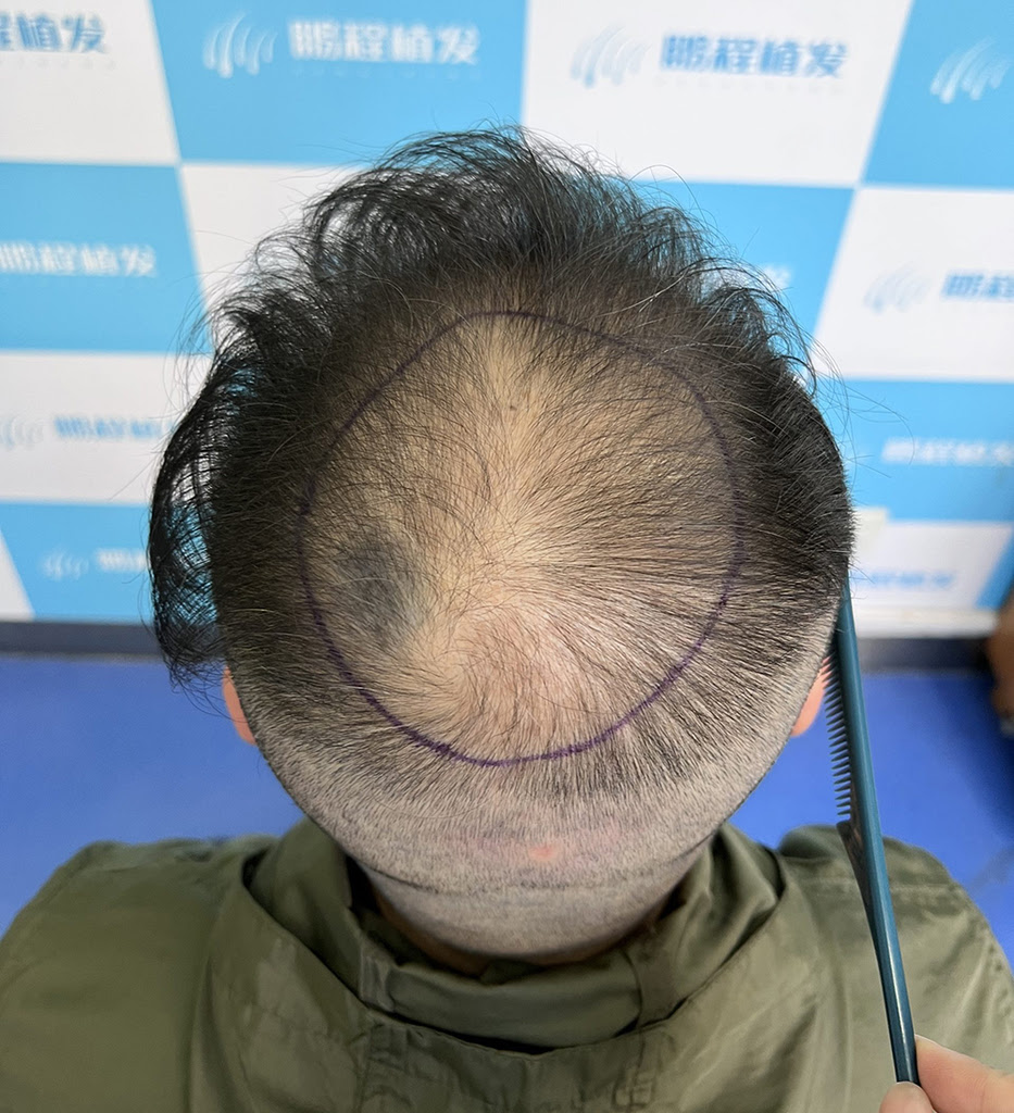 香港髮友注意！植髮唔使等光秃，黃金干預時機錯過難返！