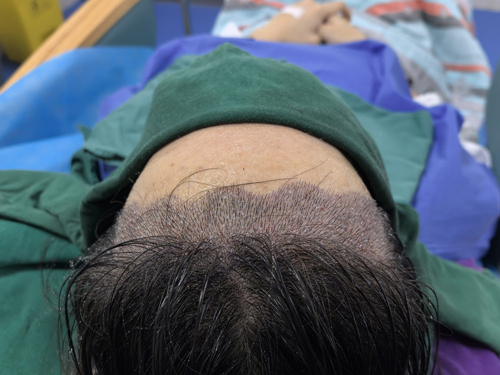 香港髮友注意！二次植髮原因大公開，3招輕鬆避開不踩坑