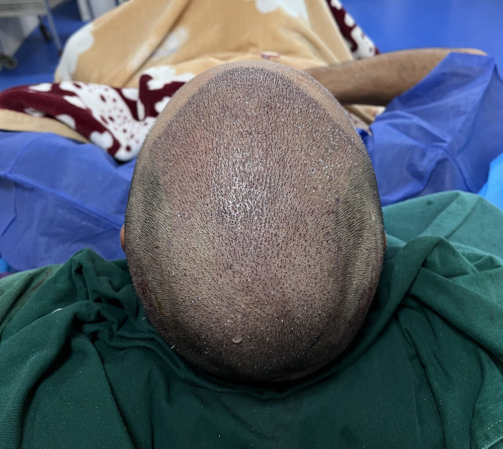 植髮後 5 年不復脫？掌握 3 大核心秘訣