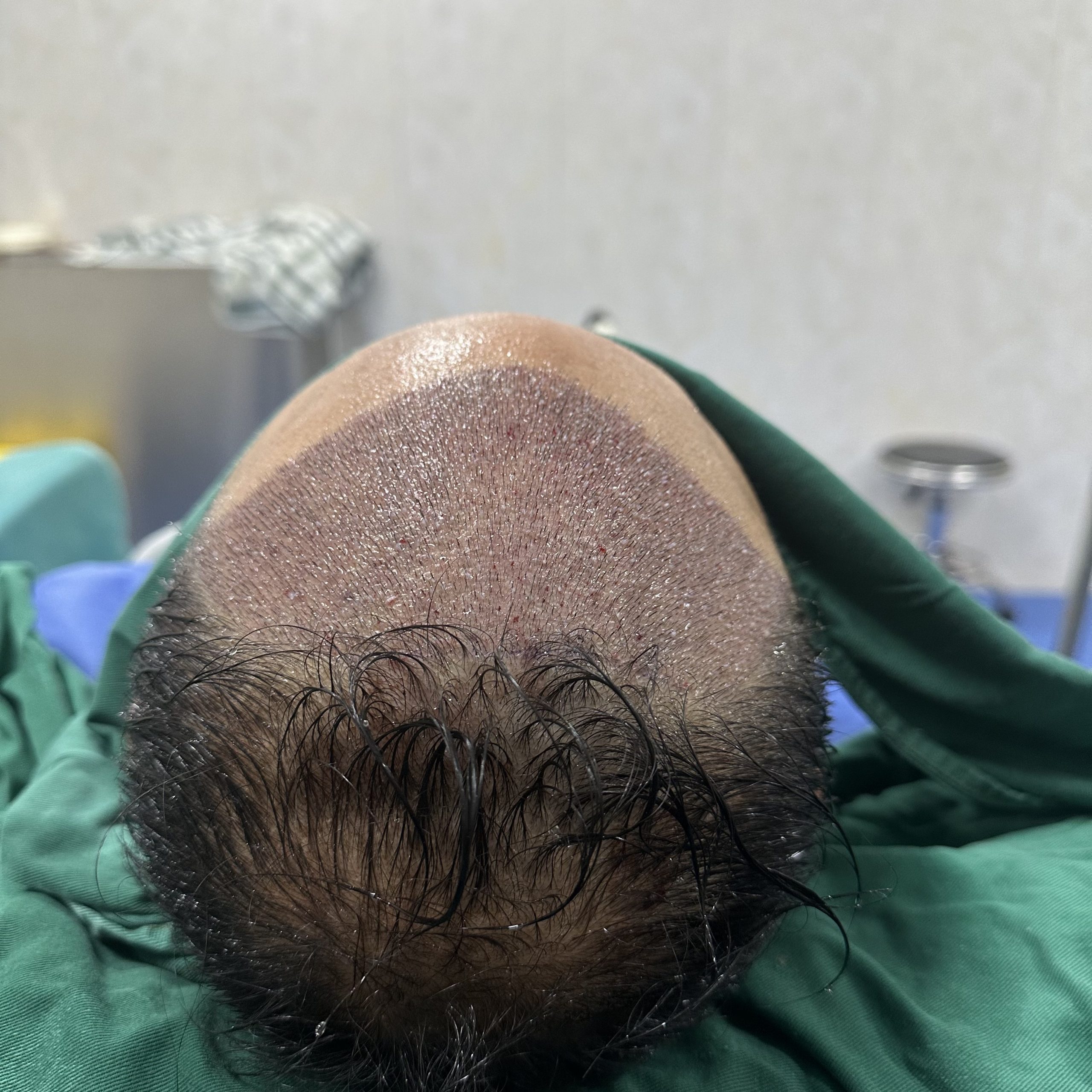 深圳植髮警惕！4大植髮誤區千萬避開