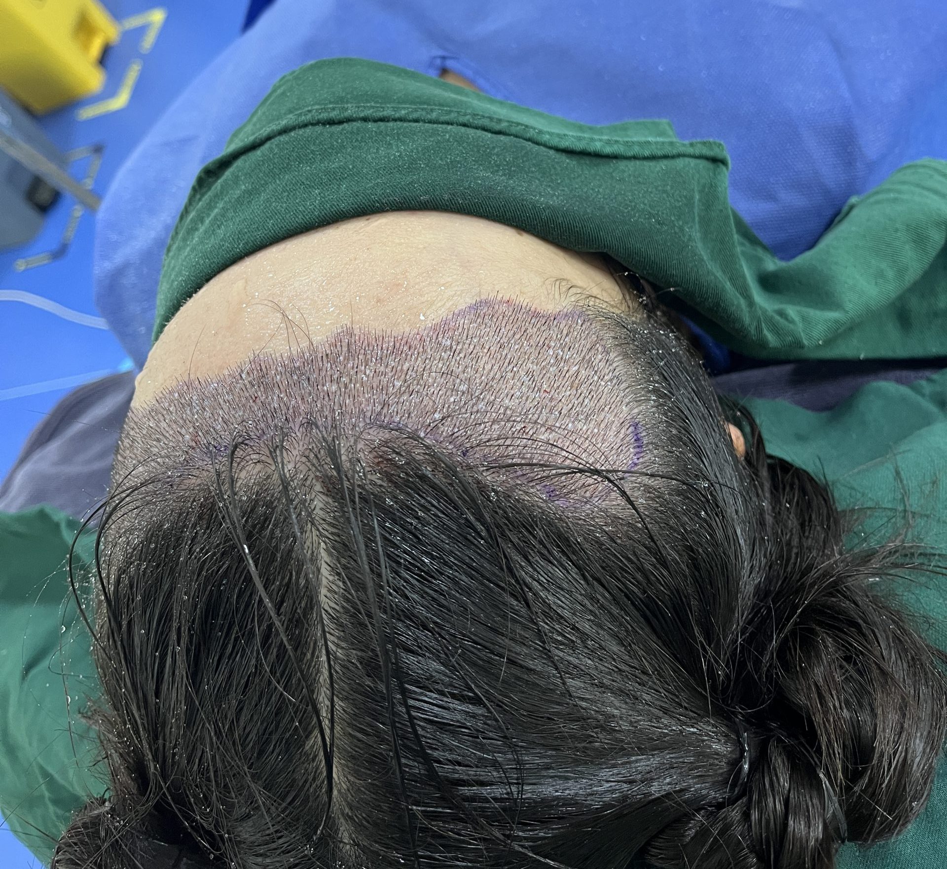 香港植髮前必看！7大植髮失敗原因大公開，避坑才能提高存活率