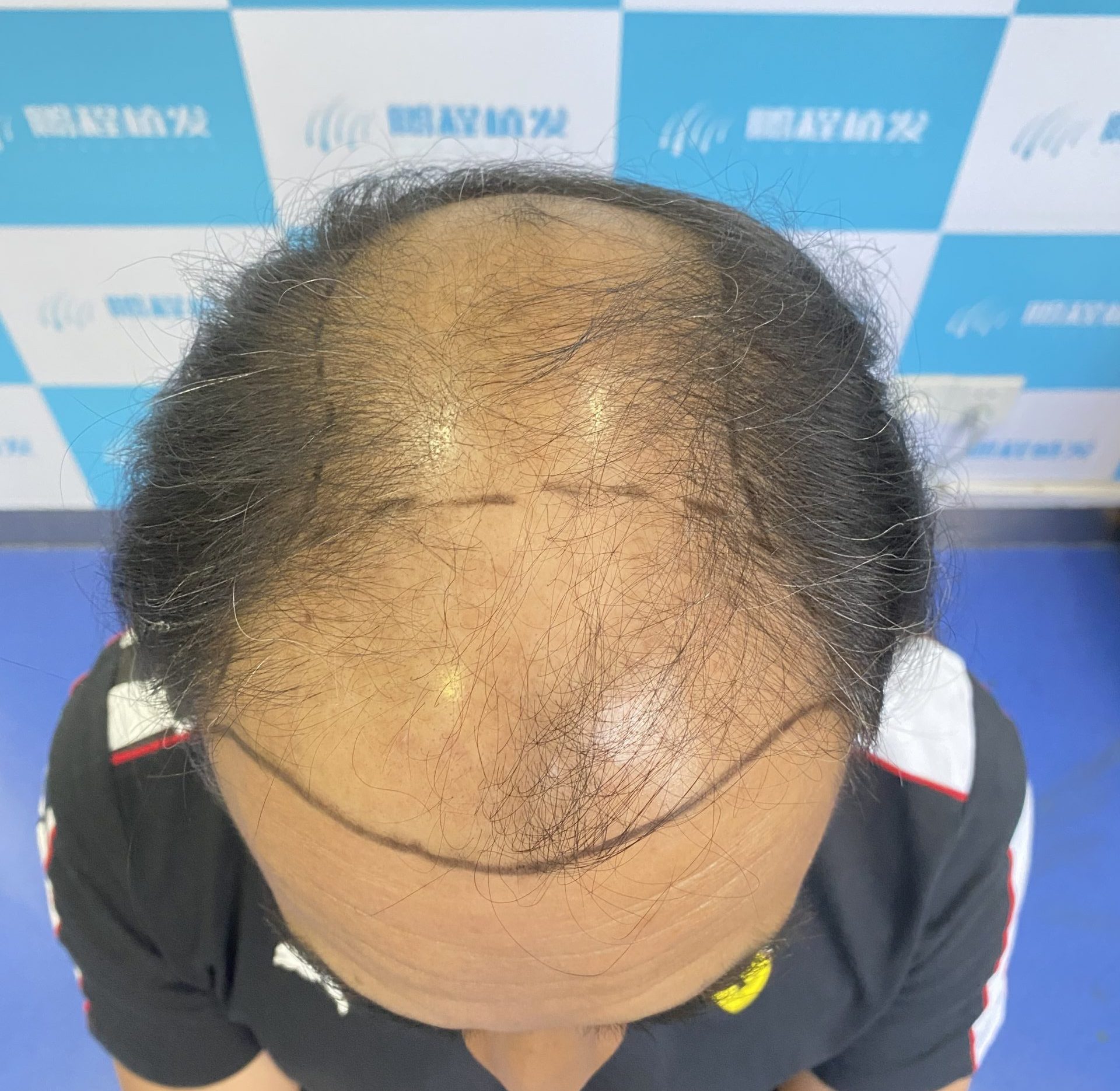 深圳植髮/髮際線種植安全嗎？揭開常見風險與避坑指南