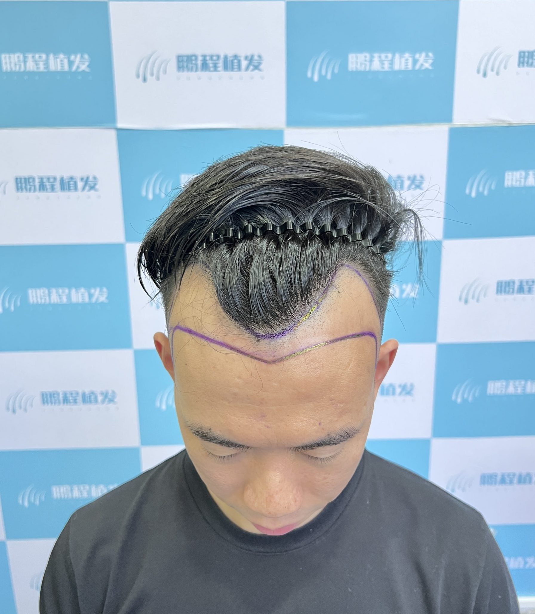 香港髮友首次深圳植髮指南｜輕鬆實現自然植髮效果的全攻略
