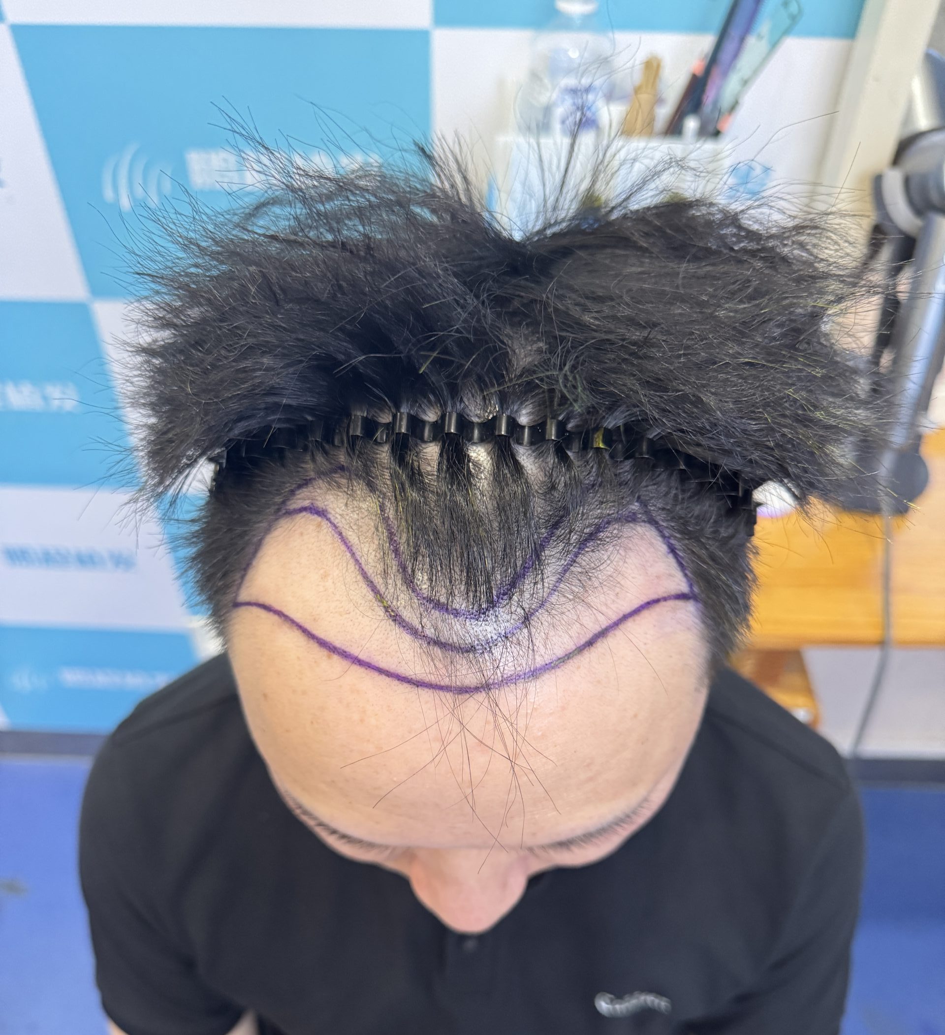 香港髮友：髮際線越來越高仲有得恢復嗎？