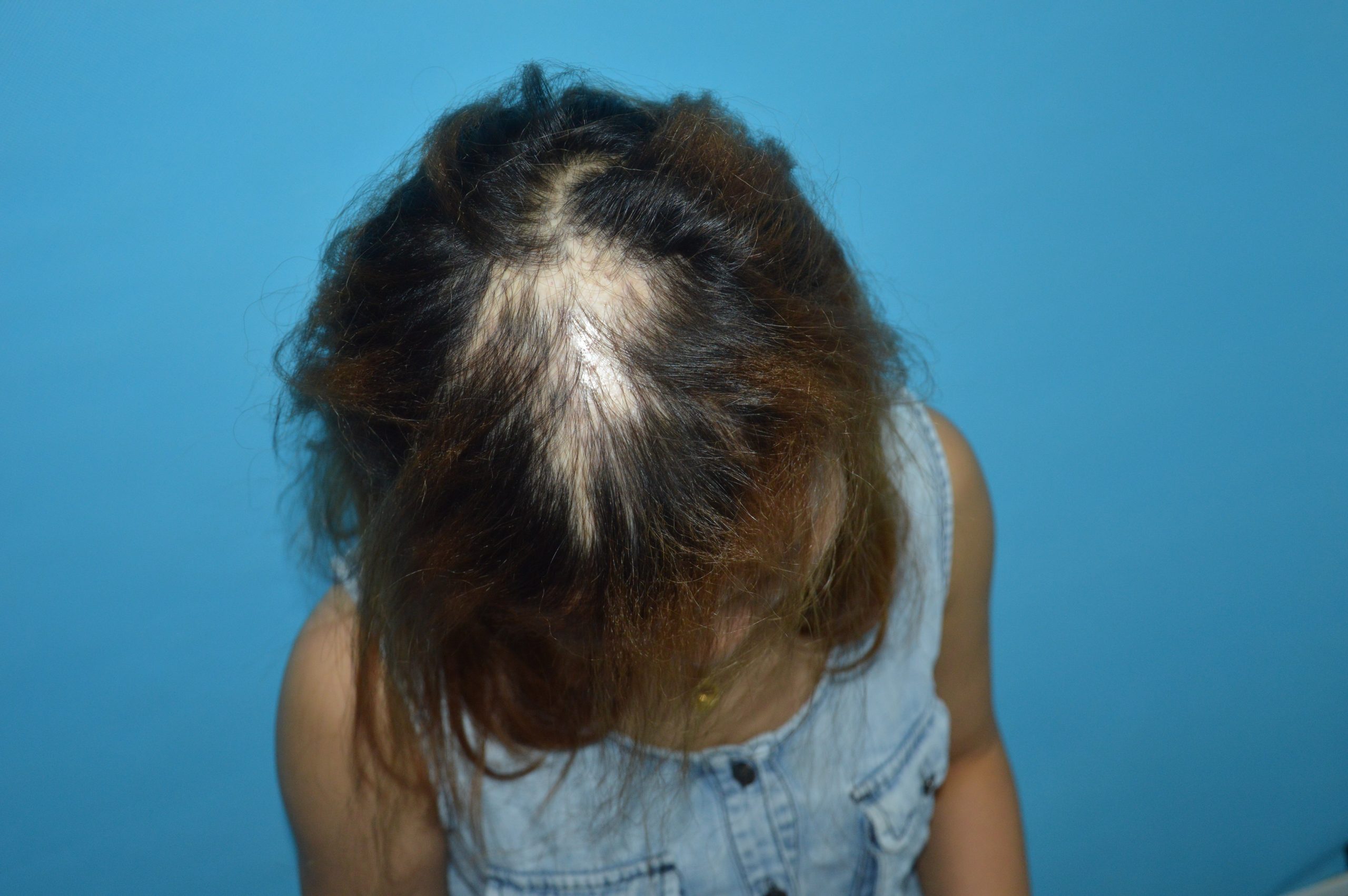 香港人留意！除咗雄脫，呢啲悄悄出現嘅脫髮都喺度「盯」住你？