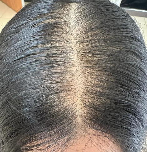 驚！頭髮變細軟隨時係禿頭前兆？香港髪友必睇 3 個判斷方法＋應對妙招