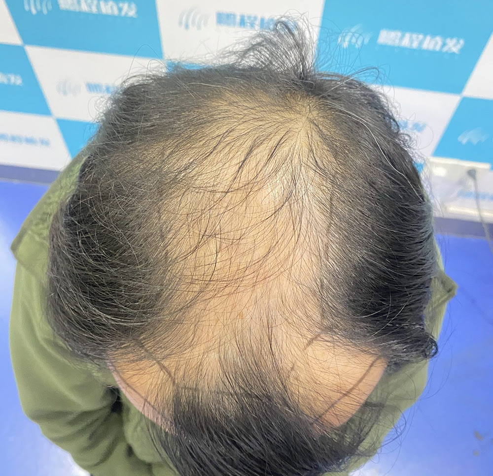 香港年輕人脫髮成潮？10 大常見脫髮疑問解答｜植髮、藥物是否有效？