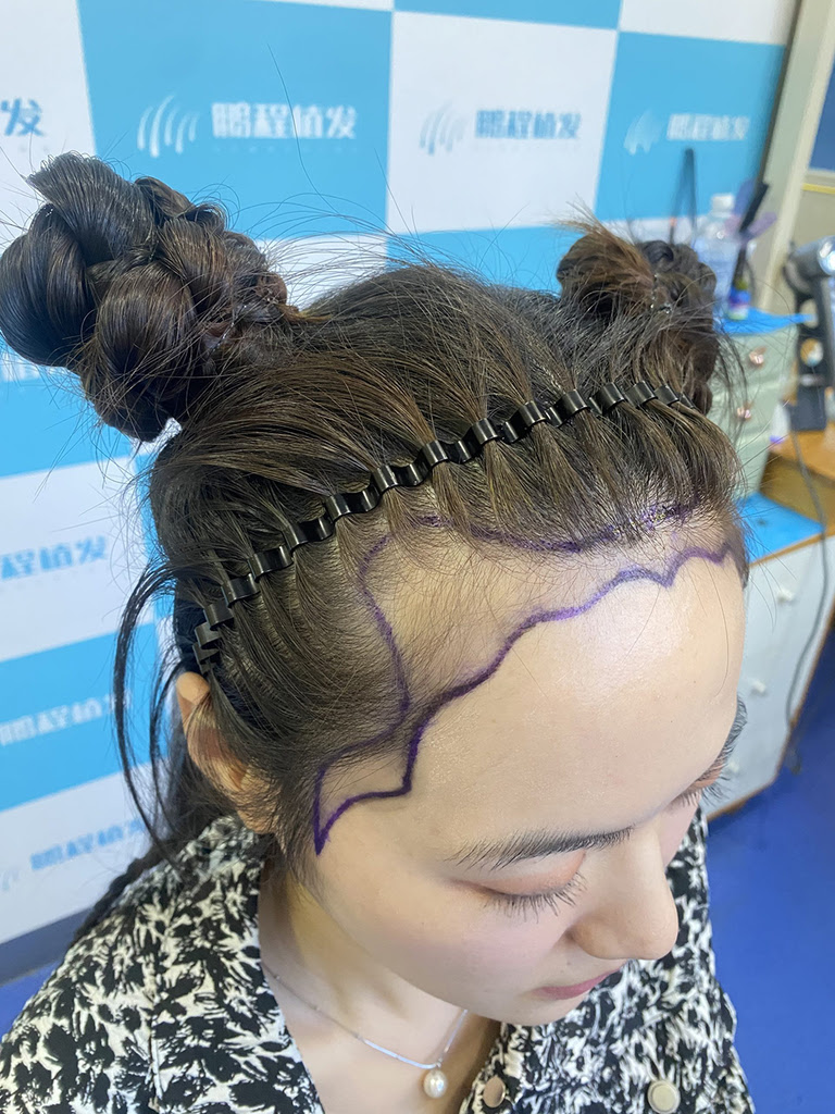 深圳植髮有後遺症？頭髮復密成功率原來靠呢幾點