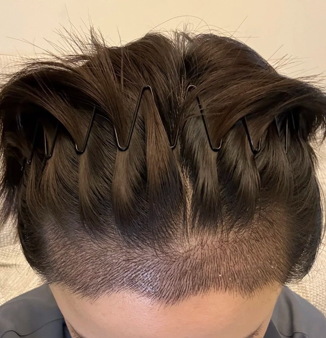 香港髪友解惑｜植髮最佳年齡？唔睇數字睇穩定！不同年齡段分析