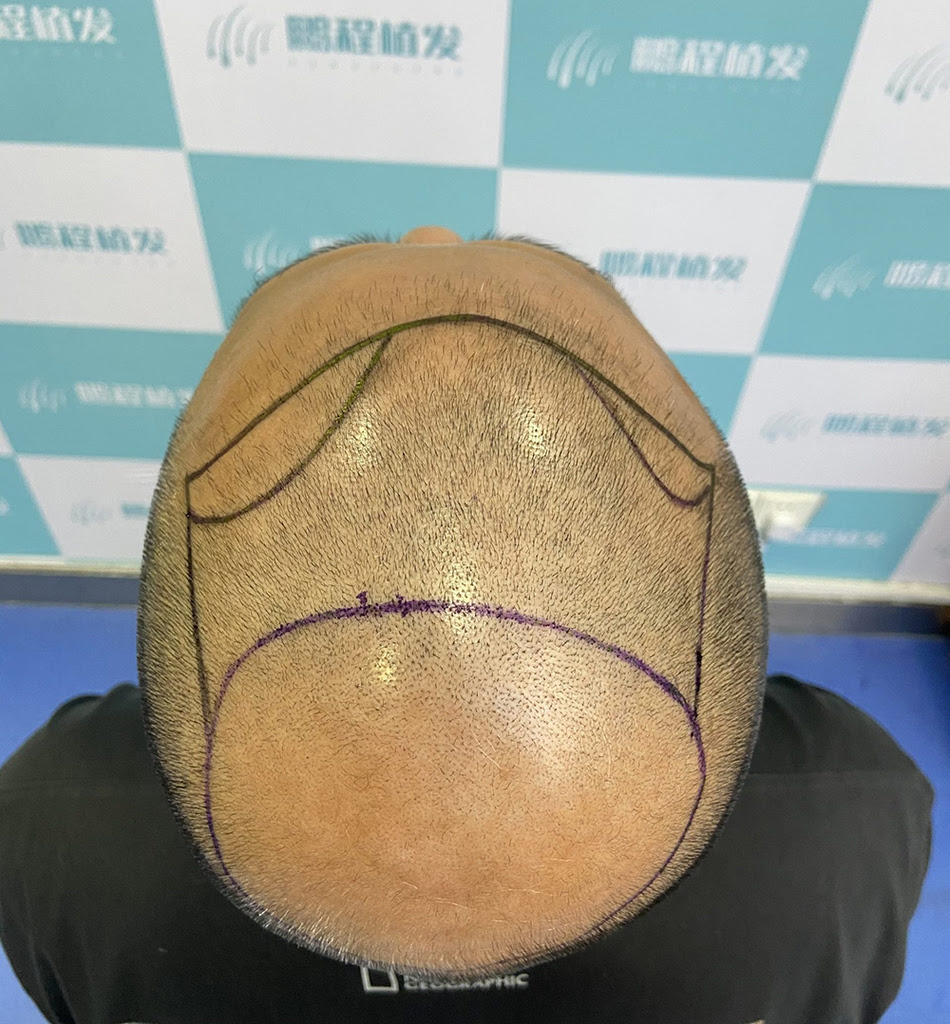 香港脫髮｜前額頭頂掉髮嚴重可見頭皮？原因 + 解決方法全解析