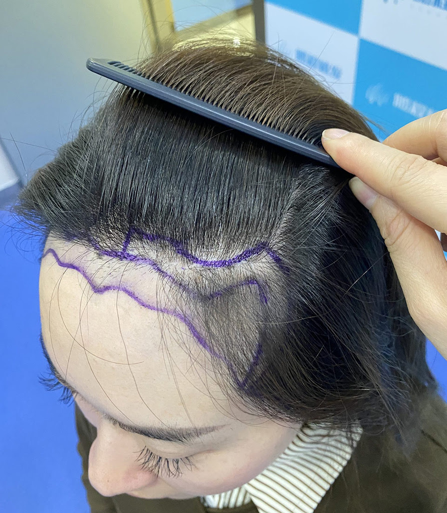 春節前在深圳植髮：新年煥新從頭始 植髮優勢與注意事項全攻略