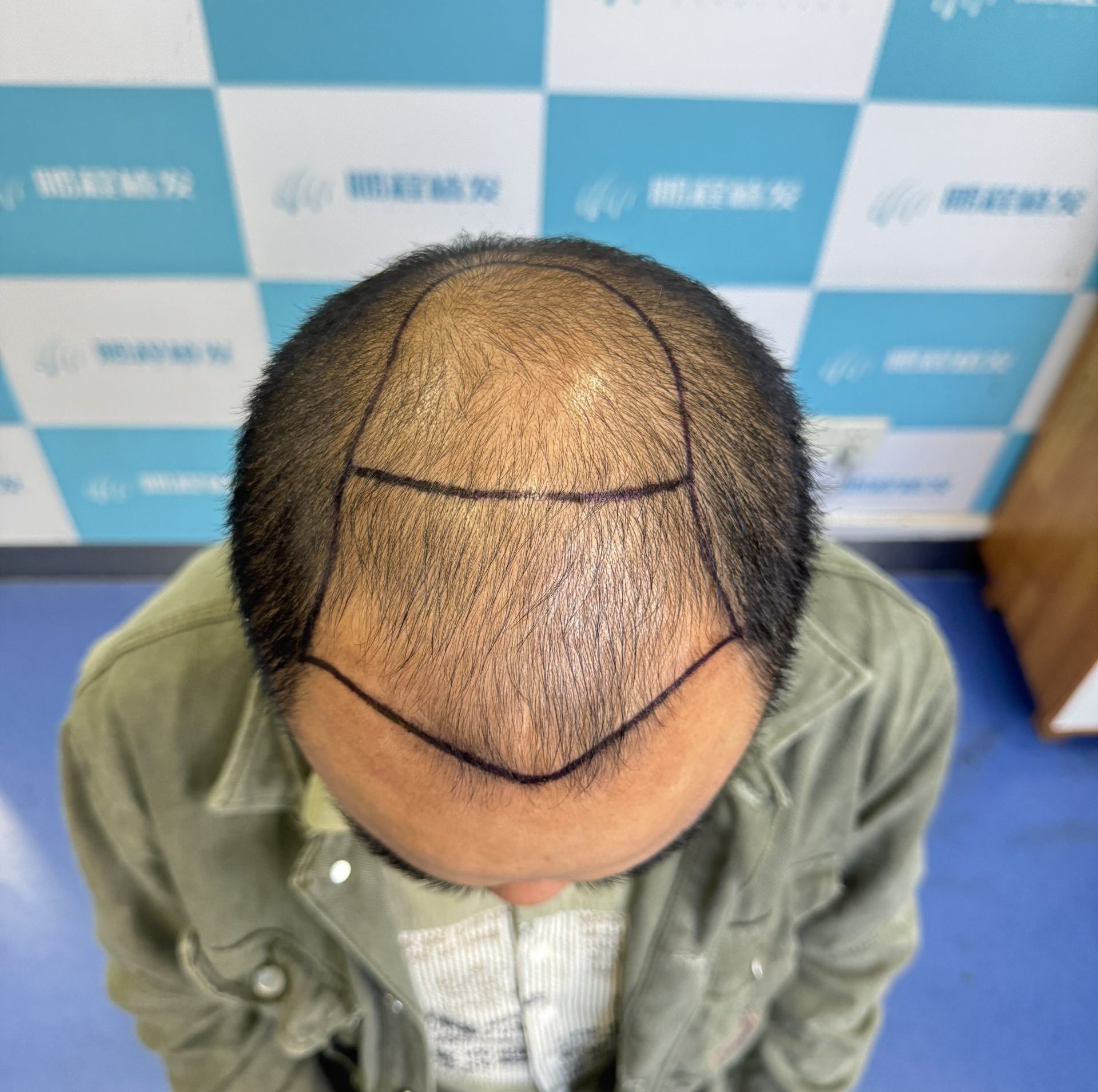 香港髪友問：脫髮禿頂但鬍鬚茂密？原因 + 植髮解決方案全解析