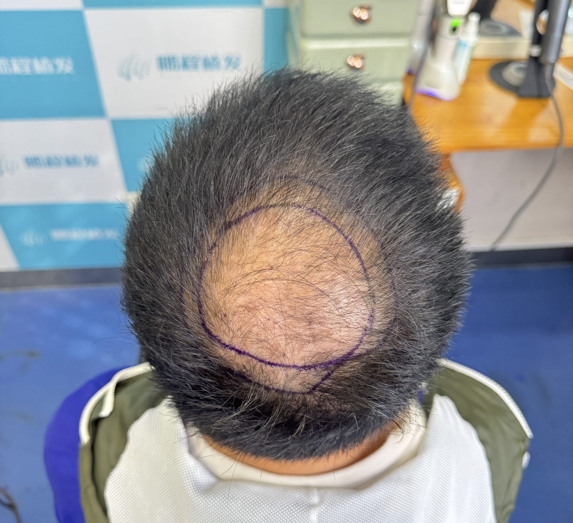 香港人年末壓力致脂溢性脫髮？熬夜掉髮真相 + 拯救髮際線方法