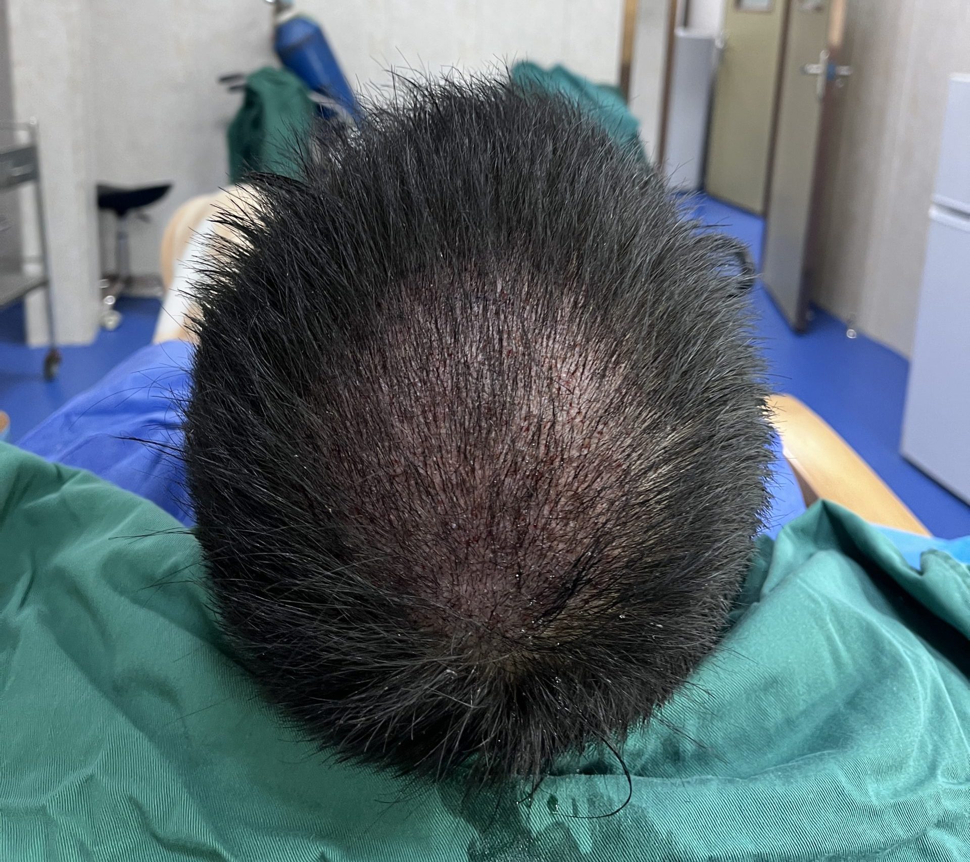 香港髮友植髮後如何順利快速度過恢復期？