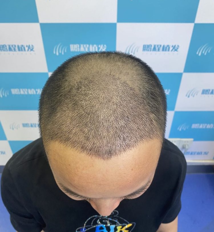 深圳植髮後洗頭，會唔會把新種植的毛囊洗掉？😟