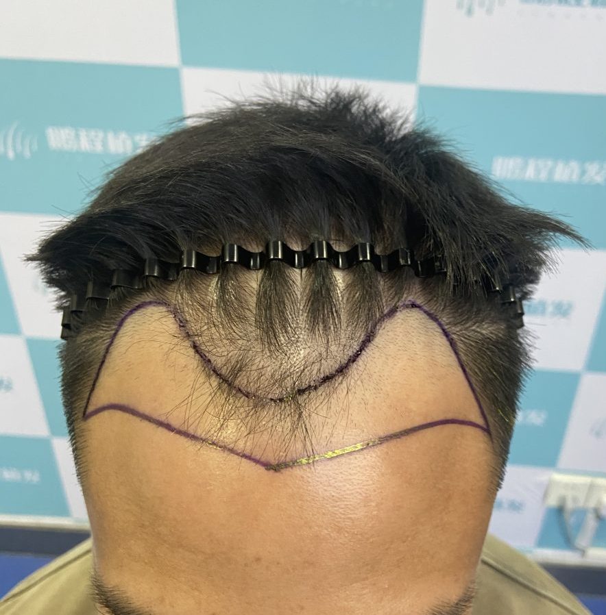 【深圳植髮】唔好俾二次種植呃錢！5 招避坑法 一次種髮夠晒持久✨