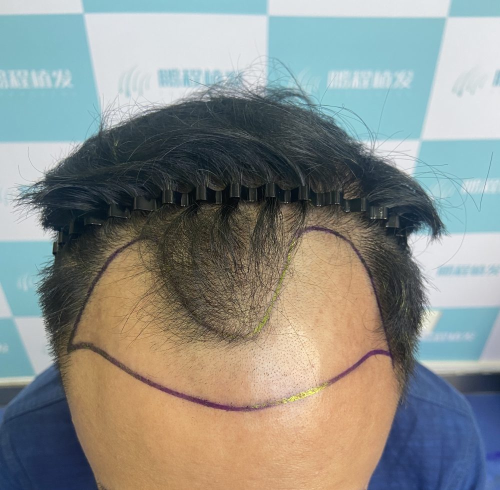 植髮效果不如預期？拆解 3 大原因 + 補救方法 香港髮友必睇