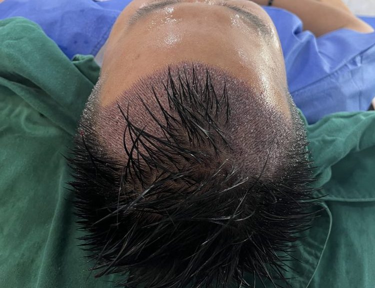 深圳植髮靠唔靠譜？內行人揭成功 / 失敗關鍵！唔想被坑一定要睇✅