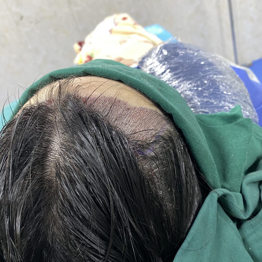 香港髮友必睇！植髮毛囊唔生得？4 個關鍵因素決定成敗