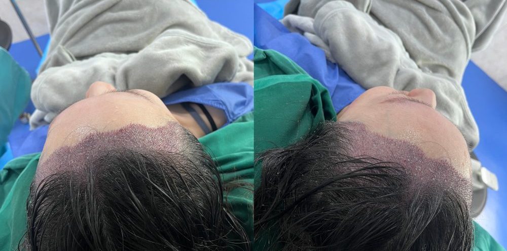 想植髮卻不敢植？香港髪友 6 大恐懼全拆解 植髮安全 / 效果 / 費用一次看清