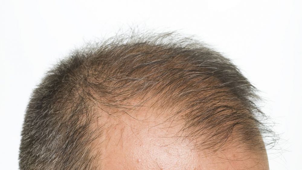 香港髪友必看 雄脫治療十大真相與謊言 遠離生髮神話交智商稅