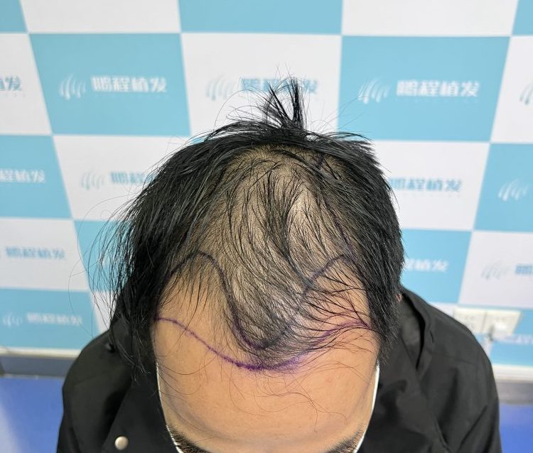 香港人脫髮告急！90%人中招的雄脫元凶公開，唔想地中海必睇