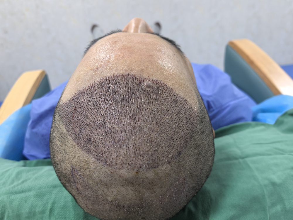 香港植髮是不是越密越好？想植髮效果佳必看的核心考量因素全解析