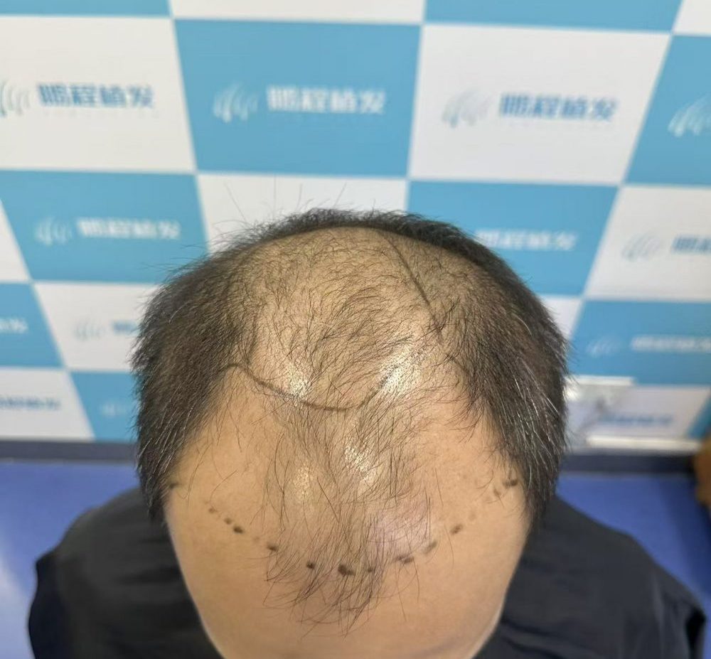 驚！植髮毛囊單位唔識揀？香港髮友避坑指南✅一文講清幾多單位先合適