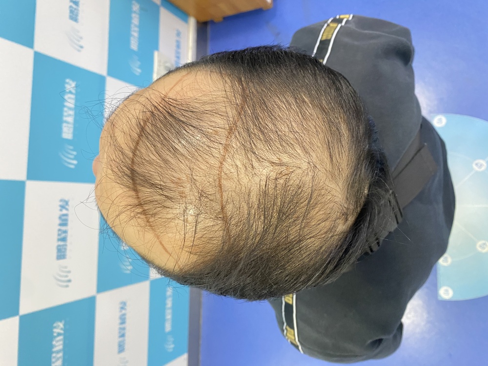 脱发情况