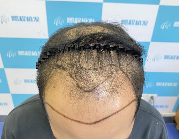 香港男仔嘅脫髮煩惱：點解總係禿成「地中海」？