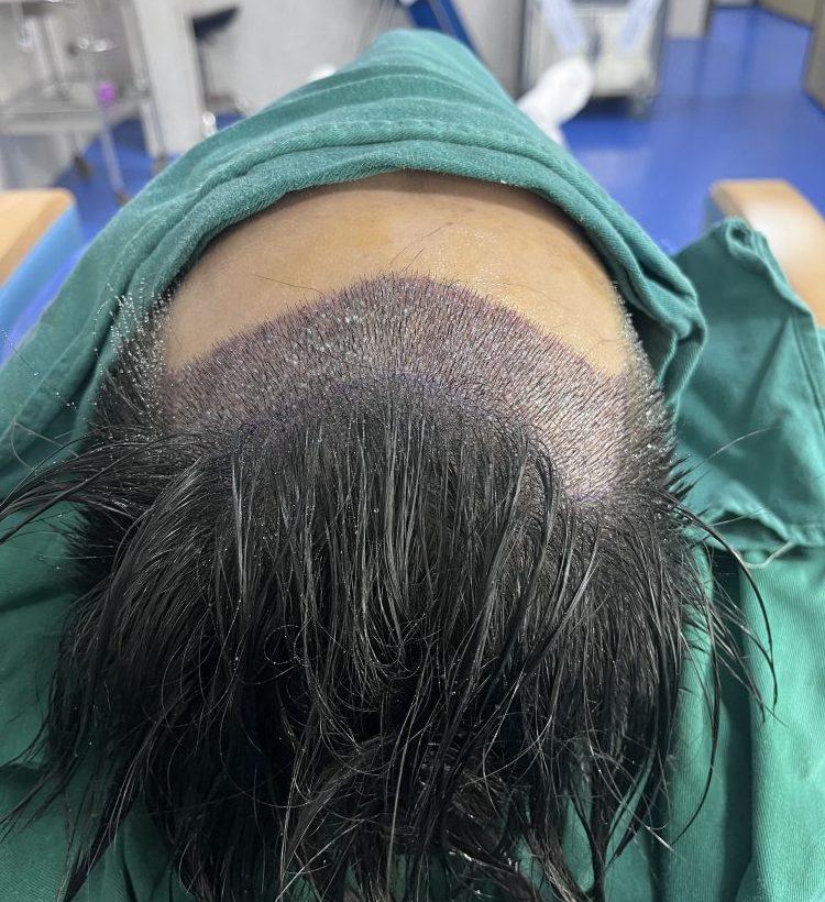 深圳植髮成功率高唔高？2026最新數據＋影響因素大公開｜附選醫指南