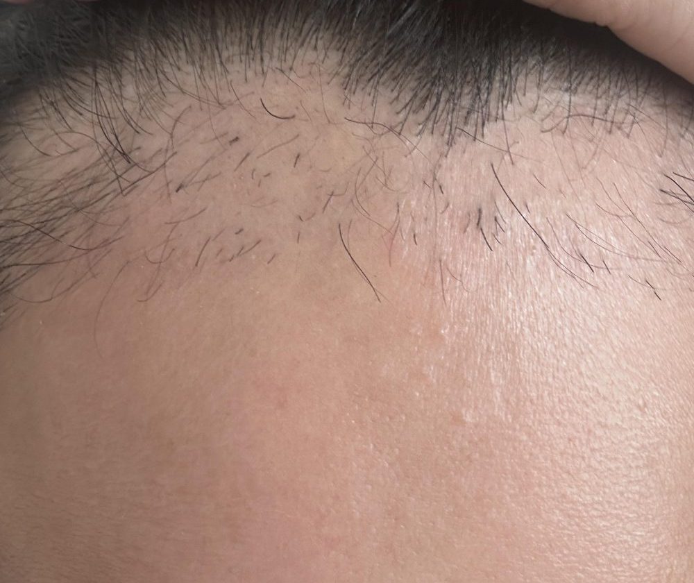 植髮失敗唔使慌😱！仲有得挽回？呢個二次修復方法救返你嘅頭髮