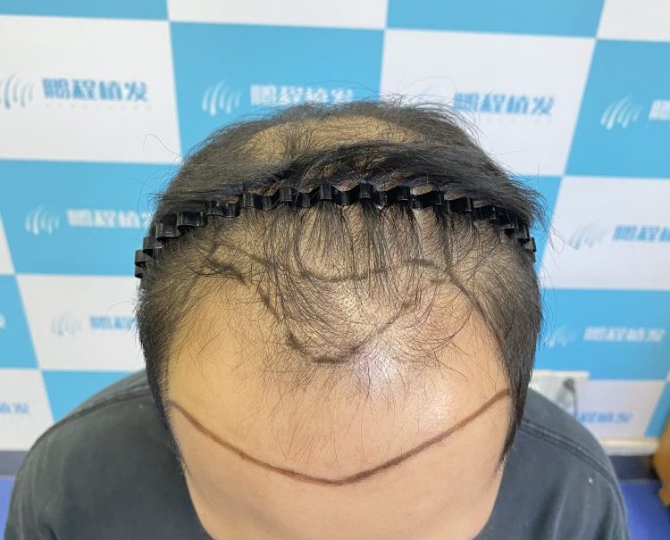 香港髪友必看：脫髮能徹底根治嗎？分清類型把握黃金治療期✅