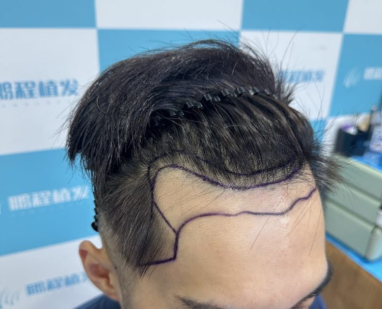 驚！30 + 香港仔髮際線後移唔使愁😱！呢幾招科學干預，即刻守住額頭髮絲