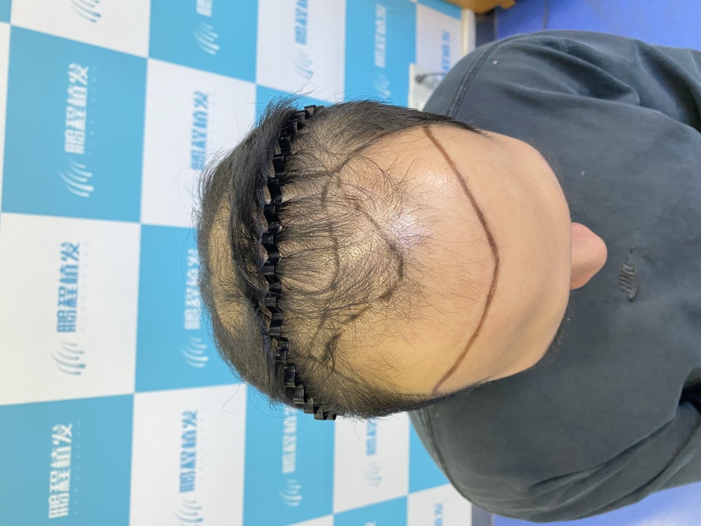 发际线前移