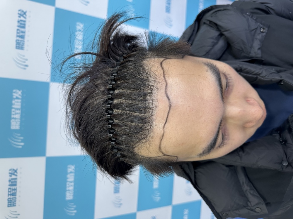 发际线后移