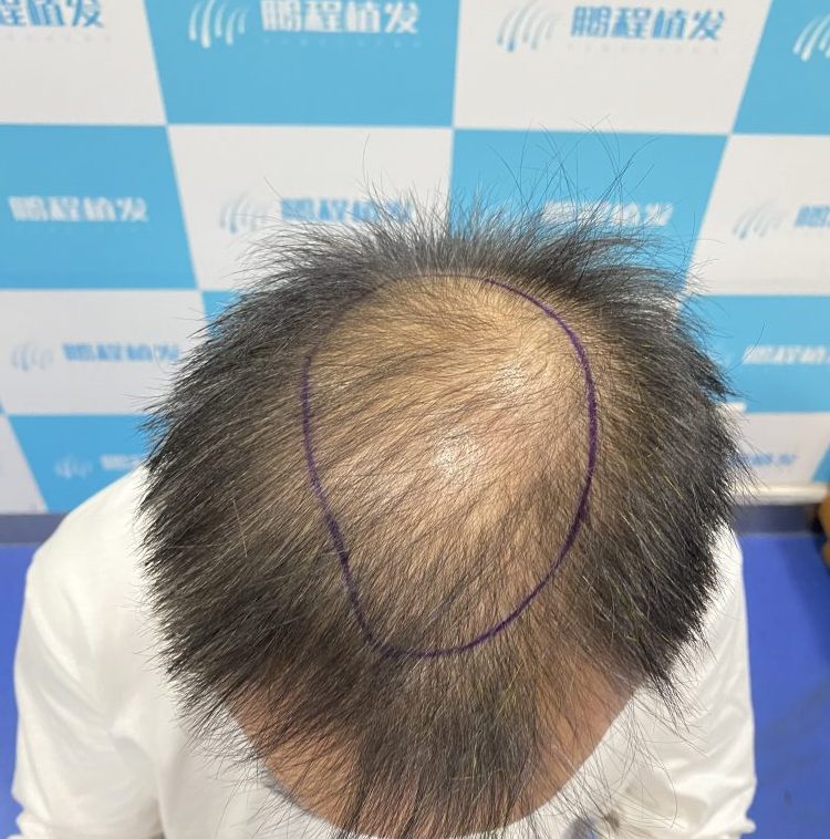 ⚠️香港朋友注意！除咗遺傳，呢 4 樣嘢正悄悄偷走你嘅頭髮！20-30 歲最中招😱