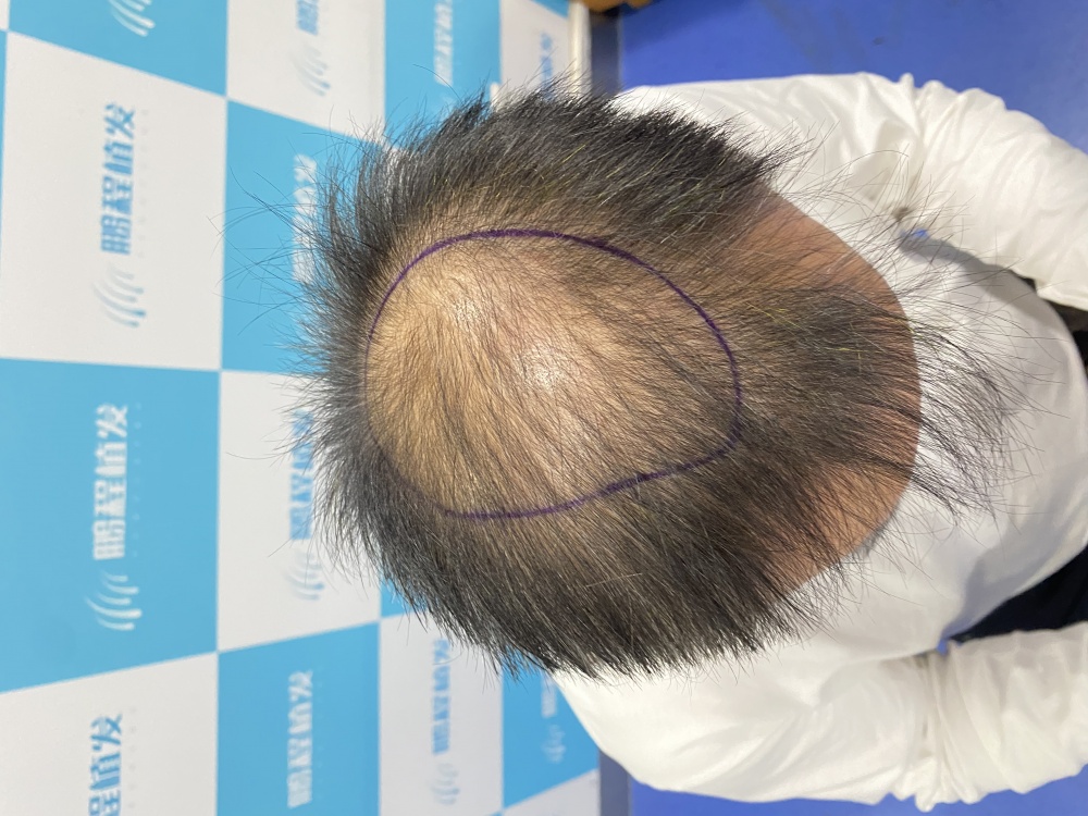 头顶稀疏