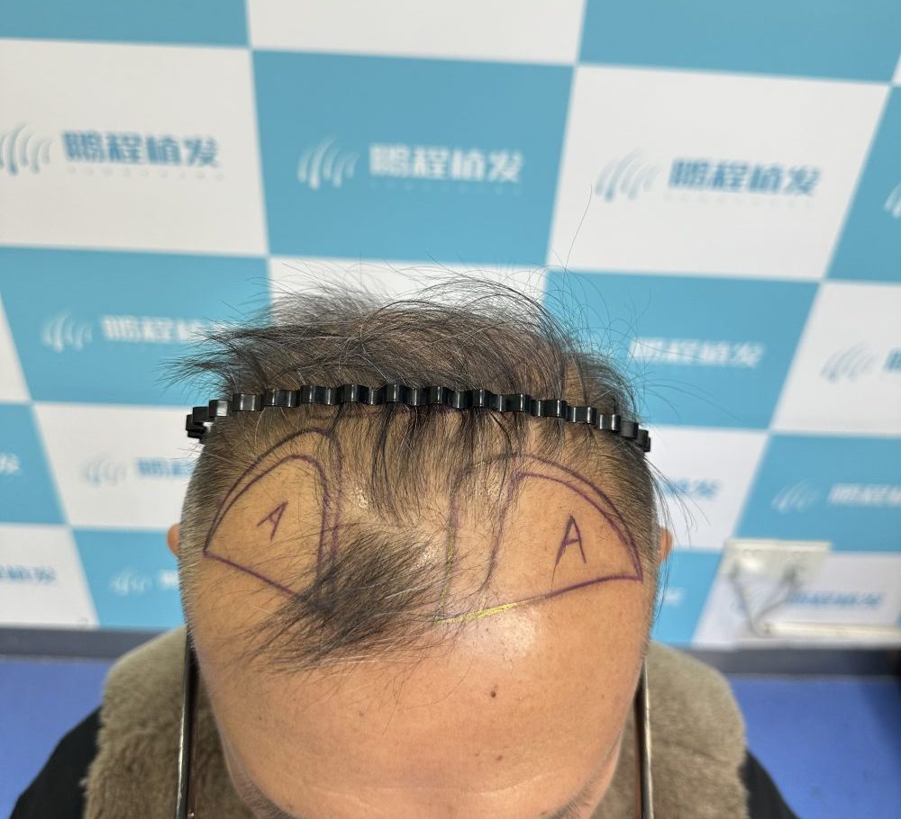 春節後掉頭髮嚴重？香港髮友必看！毛囊「節後綜合症」解救指南