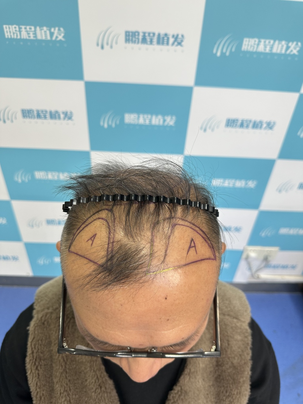 脱发问题