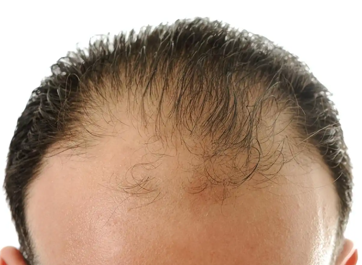 香港脫髮救星！從頭頂稀疏到發量爆棚 科學防脫 + 植髮指南｜深圳鵬程植髮醫院