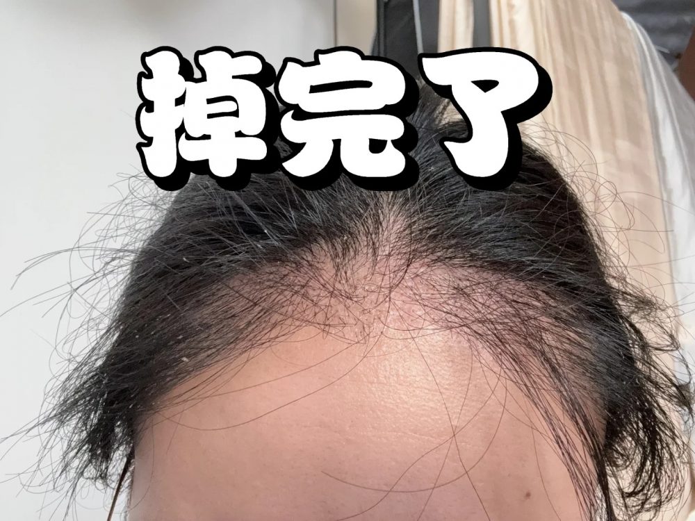 香港人植髮失敗冇得解？呢份「後悔藥」攻略，從頭救返你嘅形象！