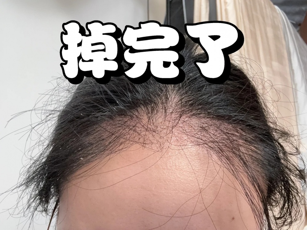 植发失败