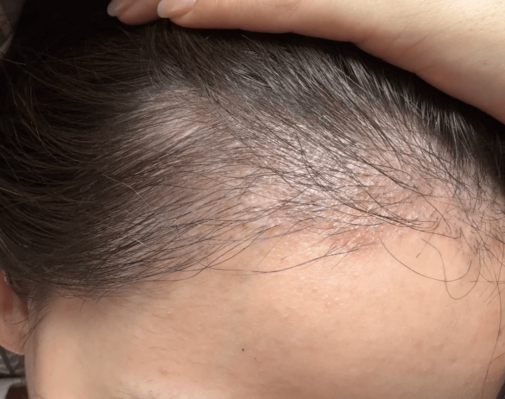 植髮失敗怎麼辦？深圳鵬程植髮醫院修復攻略 + 避坑指南｜香港脫髮救星
