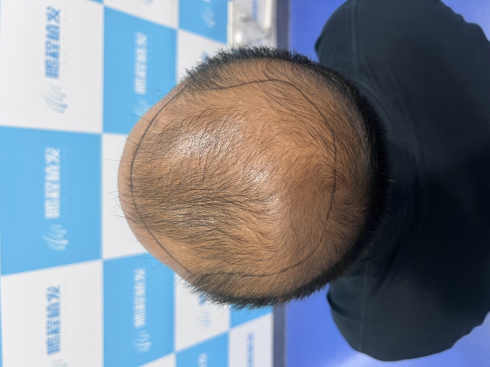 掉髮