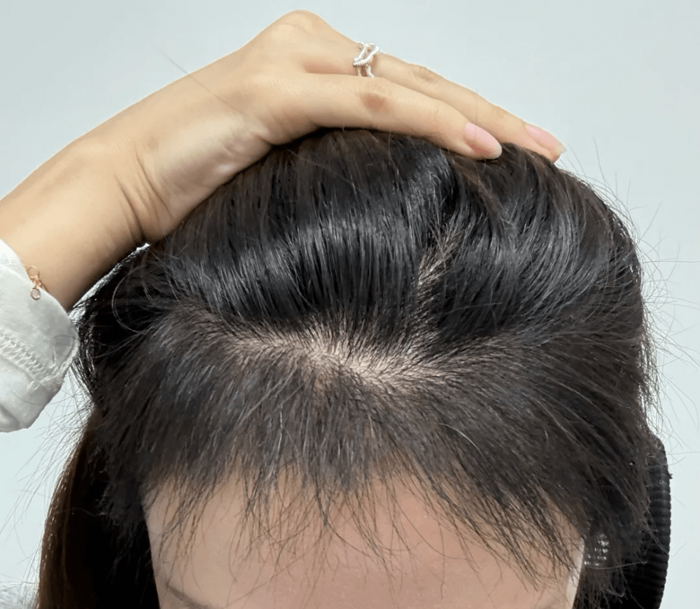 香港植髮後護理攻略｜5 大要點提升毛囊存活率 深圳鵬程植髮醫院專業建議