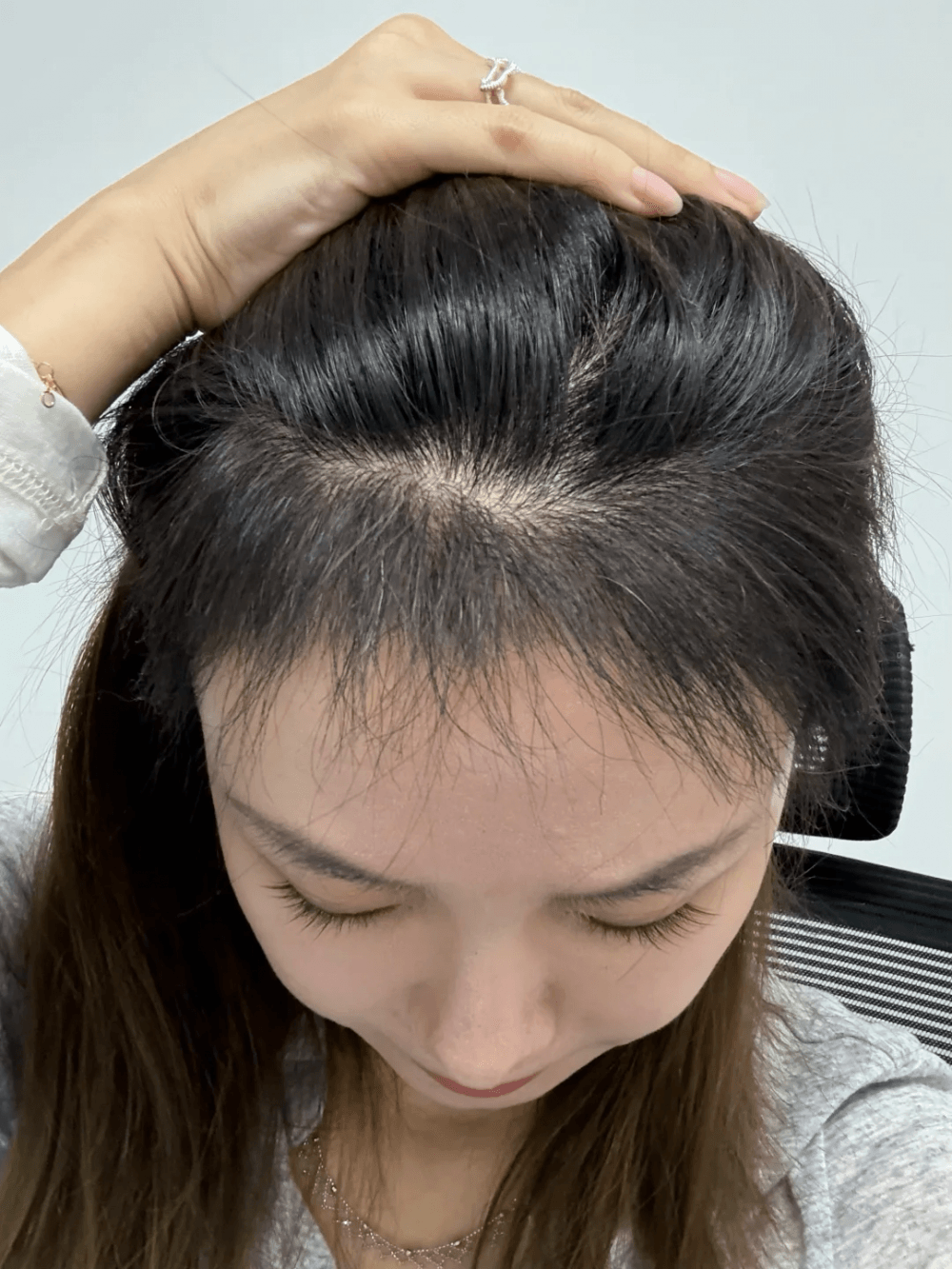 植发效果