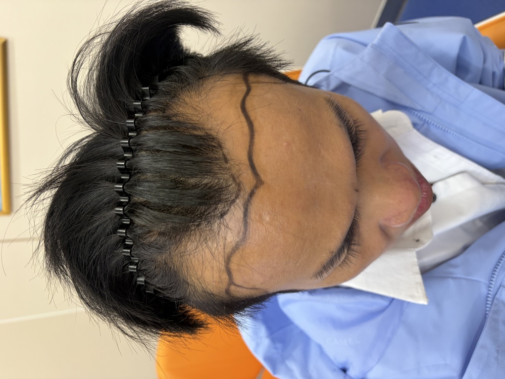 脱发