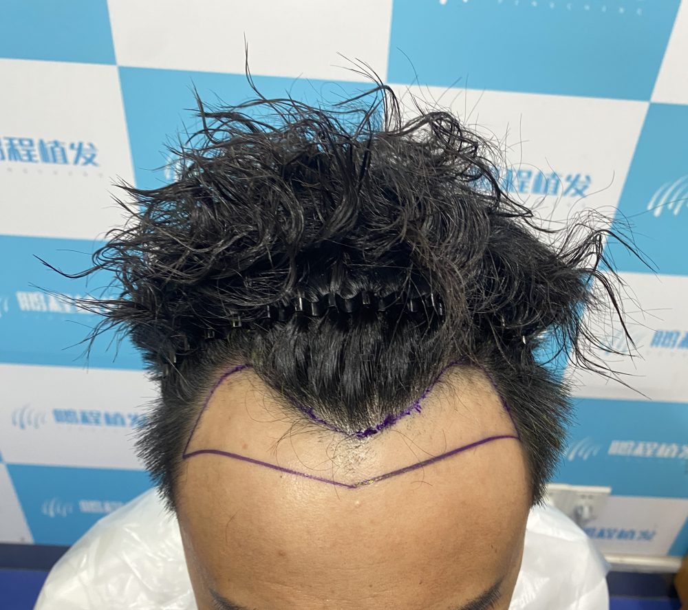 香港髮友北上植髮避坑指南｜深圳植髮性價比高？選醫院、防套路全攻略