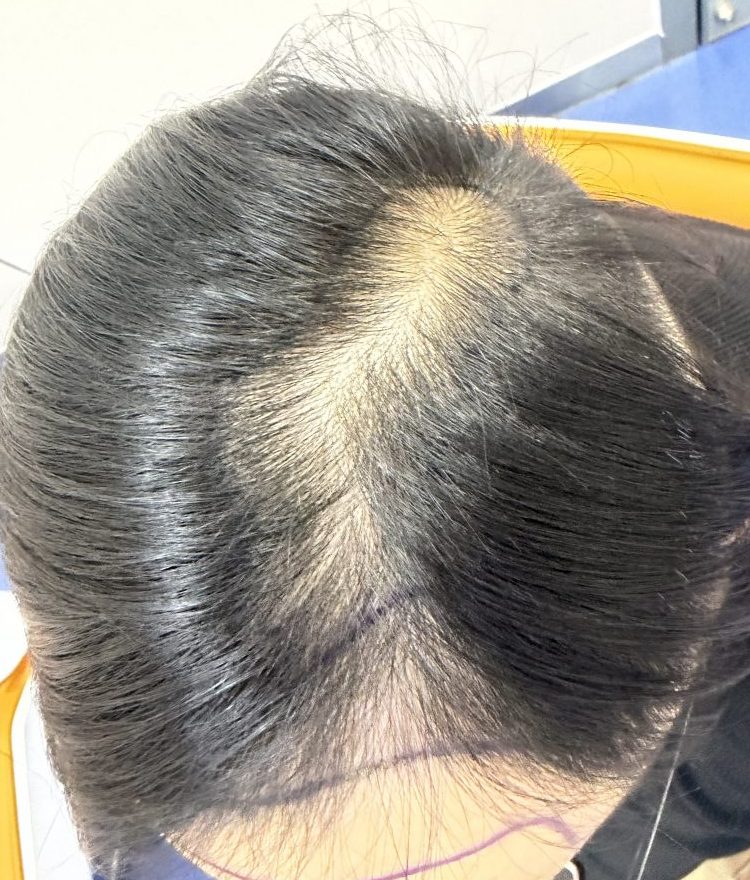 香港媽媽必看！產後脫髮需要特殊治療嗎？深圳鵬程植髮醫院教你少走彎路